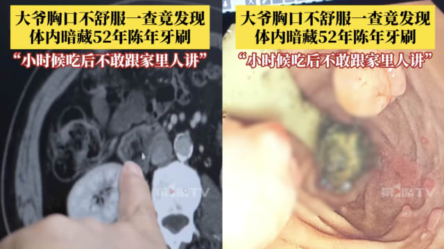 中国男子体内藏异物52年感不适 竟然是一把陈年牙刷