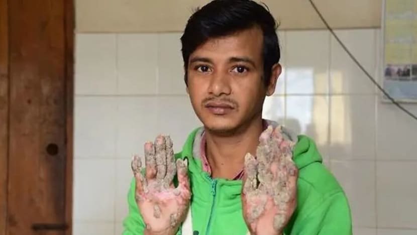 'Lelaki Pokok' yang tidak dapat tahan sakit pernah lari dari klinik
