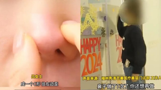 中国女子花1万多元修复鼻孔 术后鼻梁歪成C形