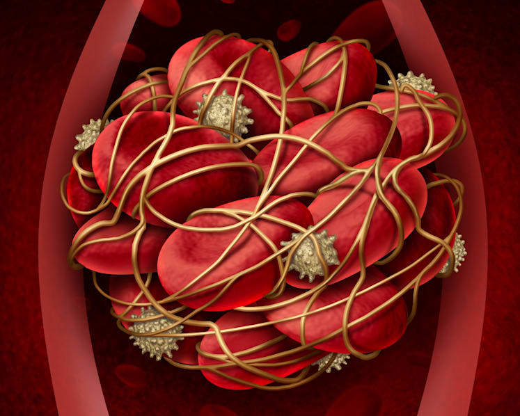 Covid-19-induced blood clots: What to know if you have diabetes, hypertension or other health issues