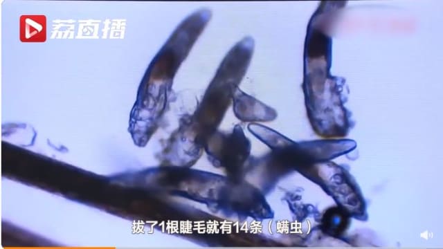中国母女眼睛干痒就医 查出眼内藏数百螨虫