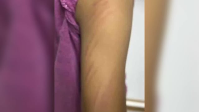 疑遭师竹棍抽打 泰国八岁女童留十多处瘀伤