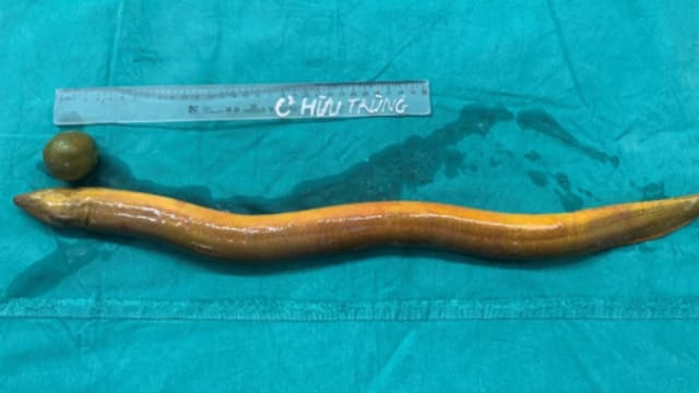 65公分鳗鱼塞肛门 年轻男子险丧命