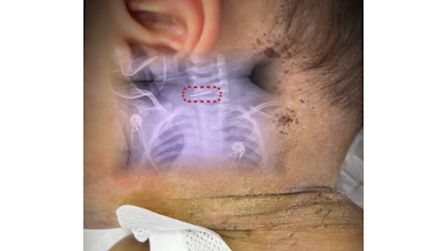 男婴遭母亲以民间疗法扎数百针 有针留体内需动手术取出