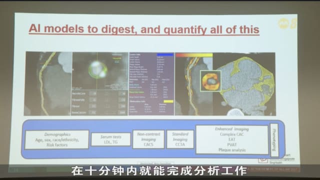国家心脏中心推出AI系统 分析扫描时间缩短至十分钟
