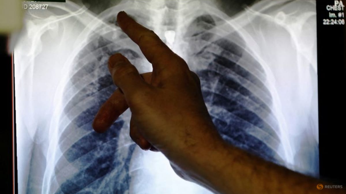 Commentary: US foreign aid cuts will undo progress in tuberculosis control – here’s what it means for Asia Commentary: US foreign aid cuts will undo progress in tuberculosis control – here’s what it means for Asia