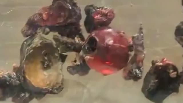 中国女子鼻塞流鼻涕十多年 求医才发现鼻腔内有串珠