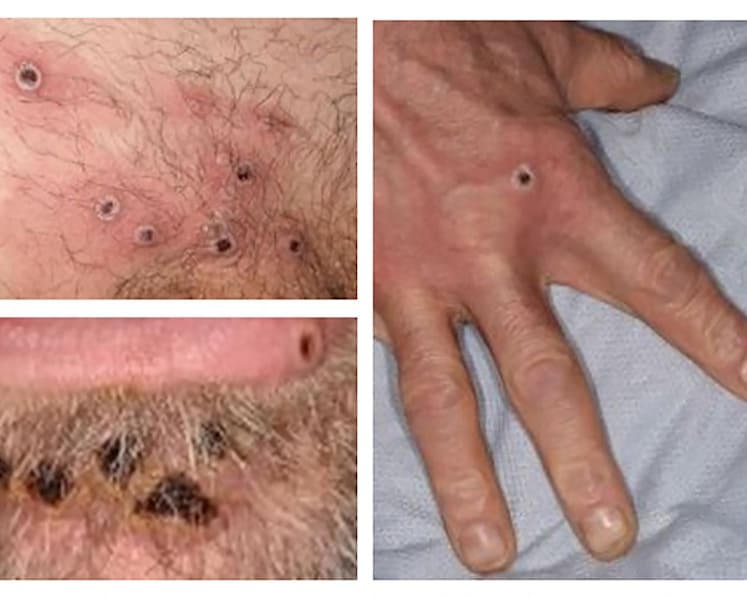 Explainer: Why monkeypox is not a 'gay disease', yet the queer community needs to heed the health risks