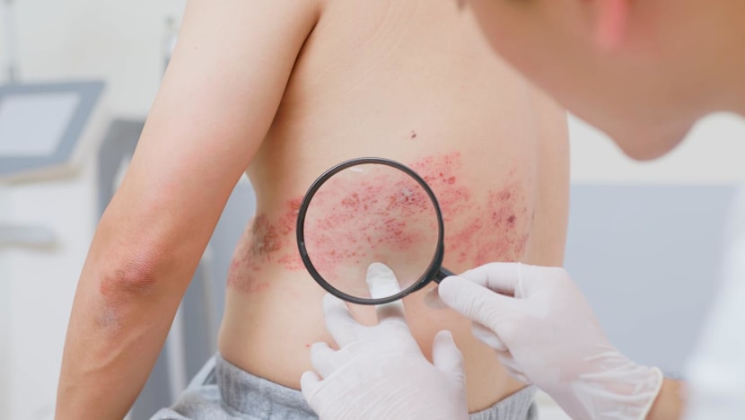 Shingles vaccine linked to fewer heart attacks and strokes, study suggests – what you need to know