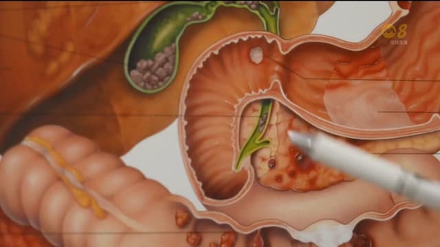 本地胆结石患者呈年轻化趋势 食物调理可改善情况