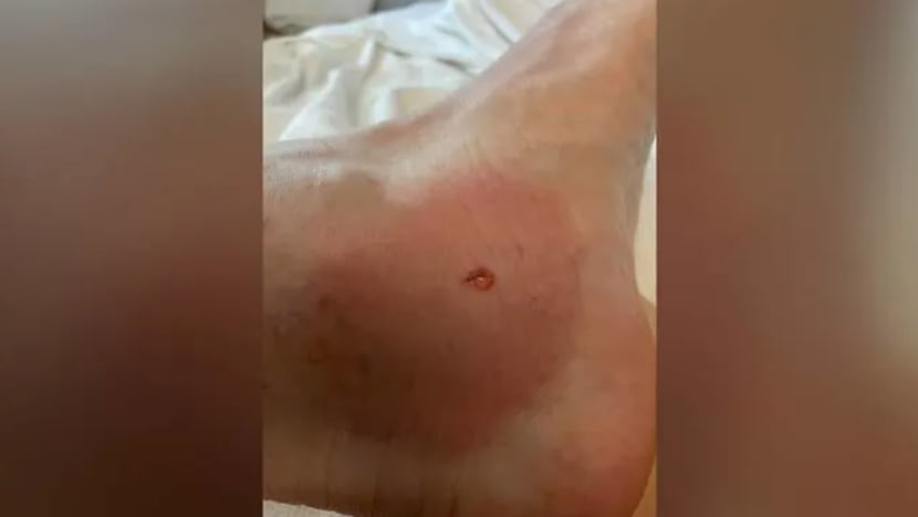 Lelaki disengat ikan pari di Pantai Tanjong Sentosa