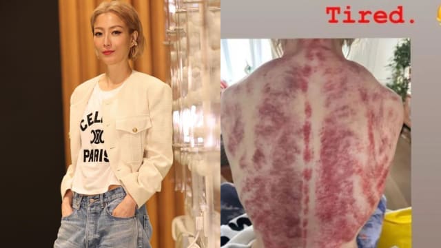 郑秀文背部“全血色”　粉丝看了备感心疼