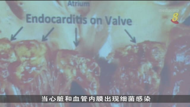 研究：心内膜炎病患中 血液培养阴性患者死亡率高出5%