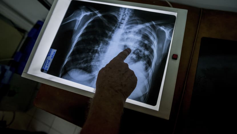 A lump on the back that turned out to be TB