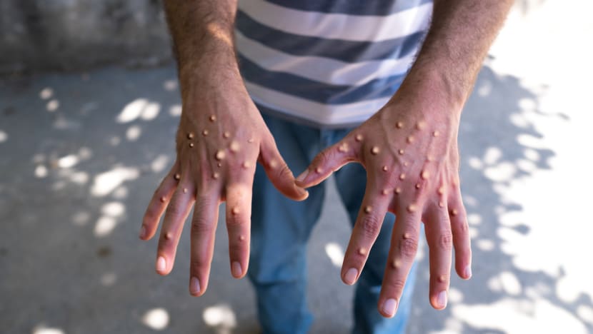 Kasus mpox melonjak di Jakarta, apa bedanya dengan cacar air?