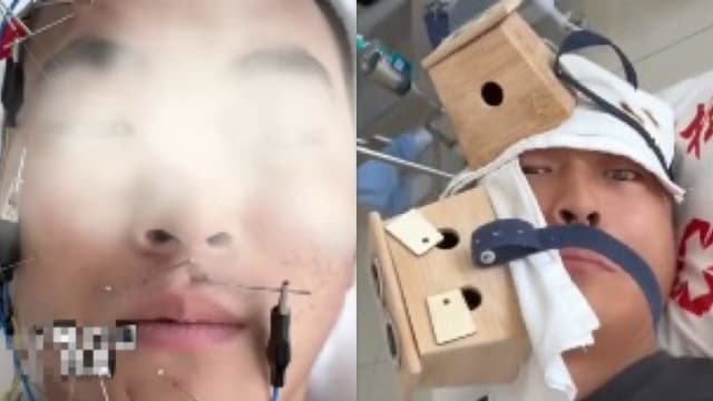 睡觉时冷气温度调太低 中国男子面瘫住院逾20天