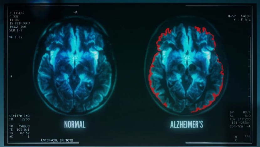 Commentary: Hard to grapple with dementia when early signs are often neglected Commentary: Hard to grapple with dementia when early signs are often neglected