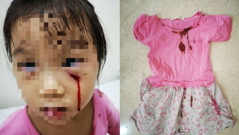 Budak 3 tahun luka 'dalam' selepas diserang burung merak; bukan mangsa pertama Budak 3 tahun luka 'dalam' selepas diserang burung merak; bukan mangsa pertama