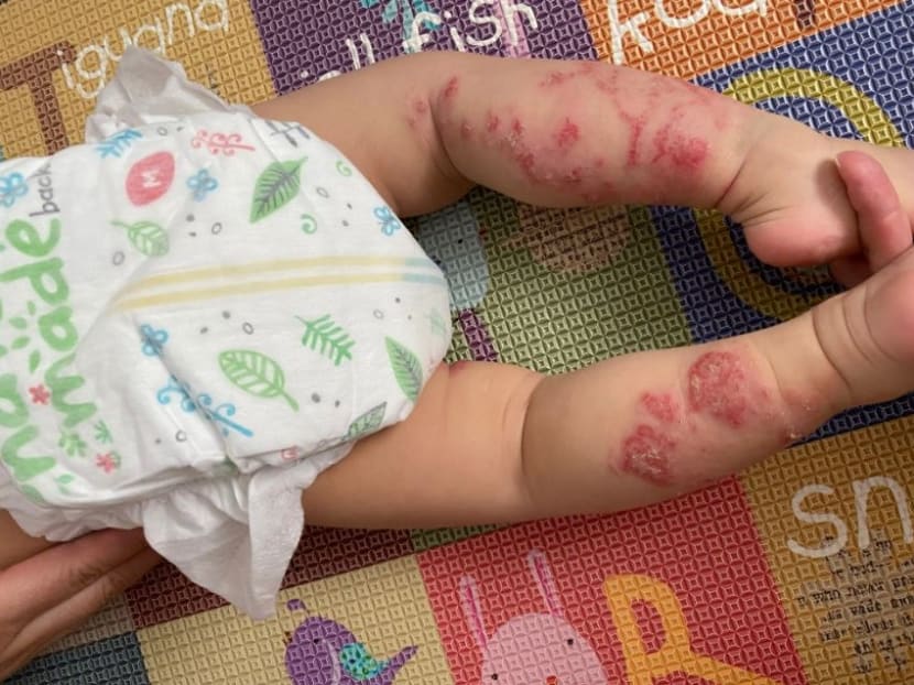 Commentary: A slice of bread could kill my child Commentary: A slice of bread could kill my child