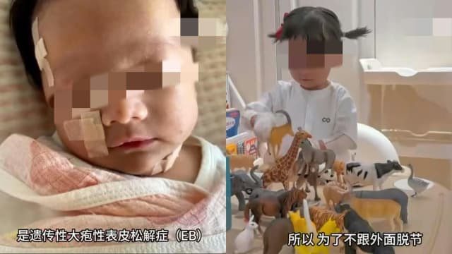 皮肤一碰就碎！中国湖南两岁女孩患罕见皮肤病“蝴蝶宝贝”