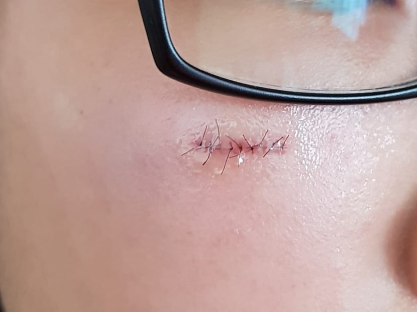 The 14-year-old girl needed nine stitches to close the cut she had sustained under her right eye.