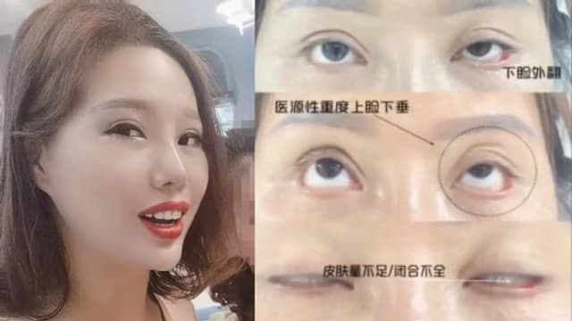 割双眼皮后无法闭眼 江苏女子发帖骂整形机构被判违约