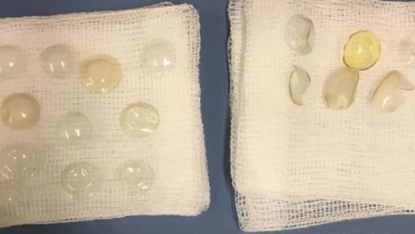 Cases of contact lenses stuck in eyes not that uncommon in Singapore, specialists say