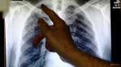 Commentary: We’re losing ground in the global fight against tuberculosis