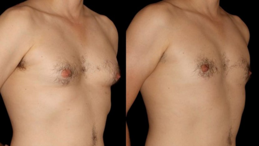 Men seek breast reduction to get load off their chest