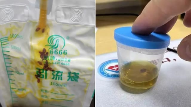 半年前吃过淡水鱼生 中国厨师胆管布满虫子