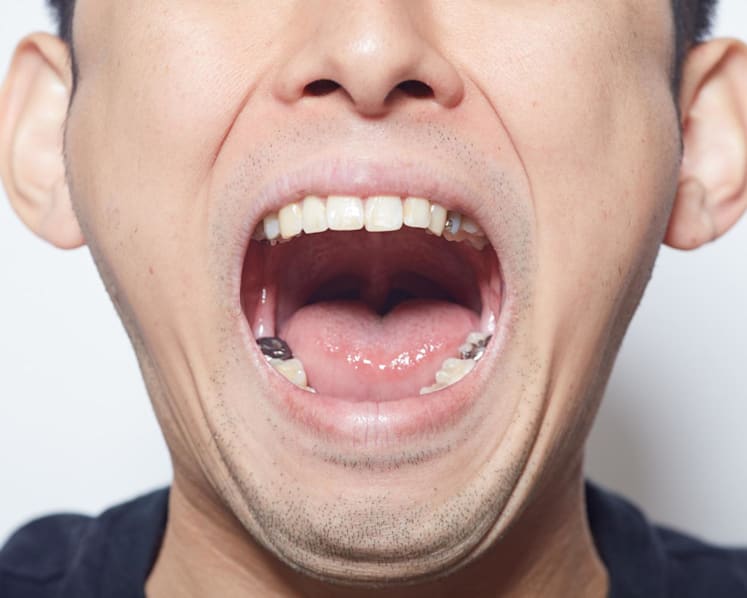 You could start losing teeth in your 30s – how to keep the rest of them before it’s too late