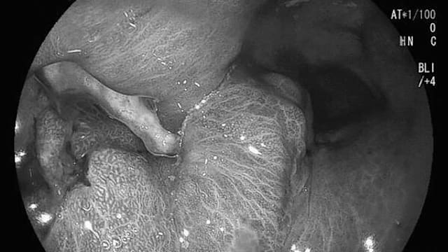 口臭腹胀频打嗝误当上火 台男确诊胃腺癌