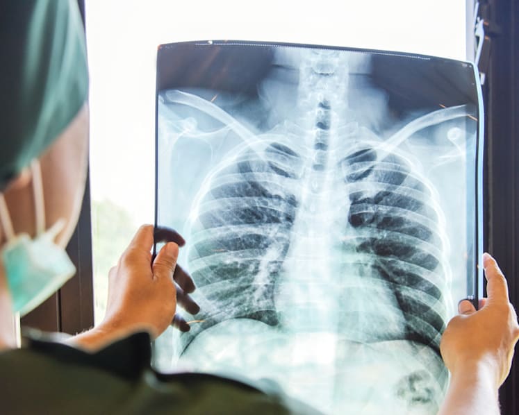 What to know about lung cancer and its common gene mutations