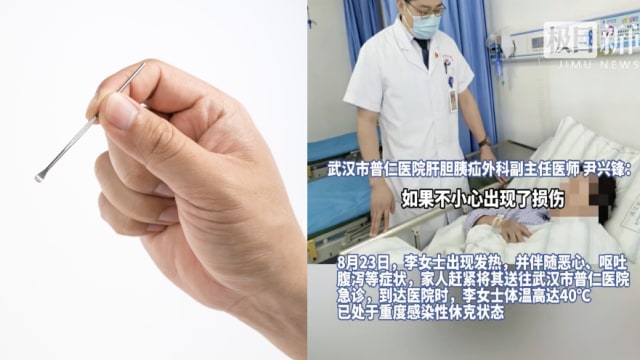 女子挖耳朵太用力 致耳膜破裂感染险丢命