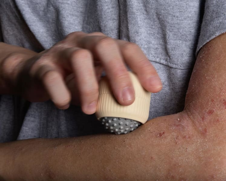 Invention to relieve eczema itching runner-up in James Dyson Award; winning entry helps stroke sufferers