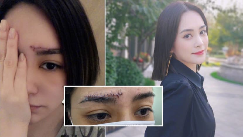 Gillian Chung Shows Off 6cm Scar On Forehead That She Got From Falling In Her Hotel Room Gillian Chung Shows Off 6cm Scar On Forehead That She Got From Falling In Her Hotel Room