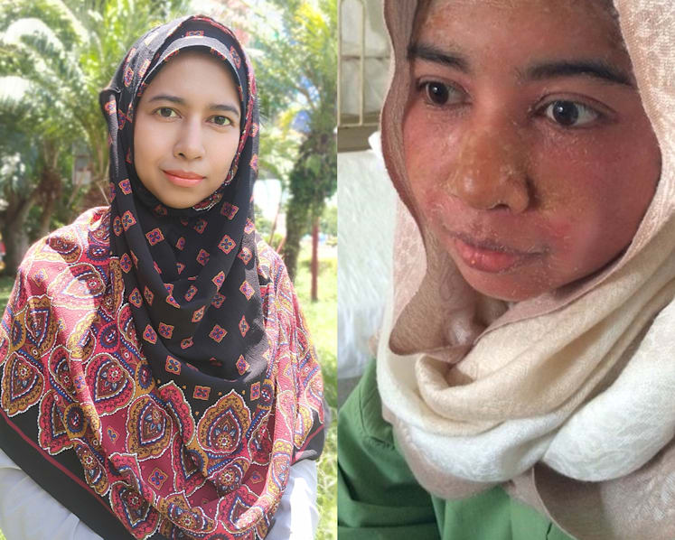 She got her master’s degree and raised four children, even as she battled a painful, incurable skin disease