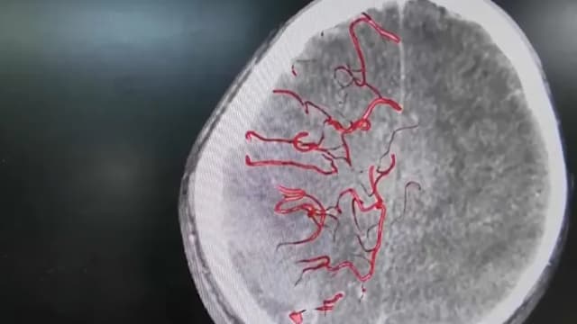 中国10岁男童自行拔蛀牙 严重感染引发脑出血