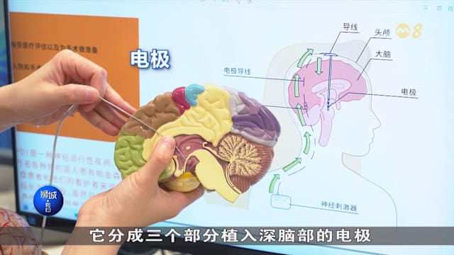 狮城有约  | 深部脑刺激术 有望控制帕金森症