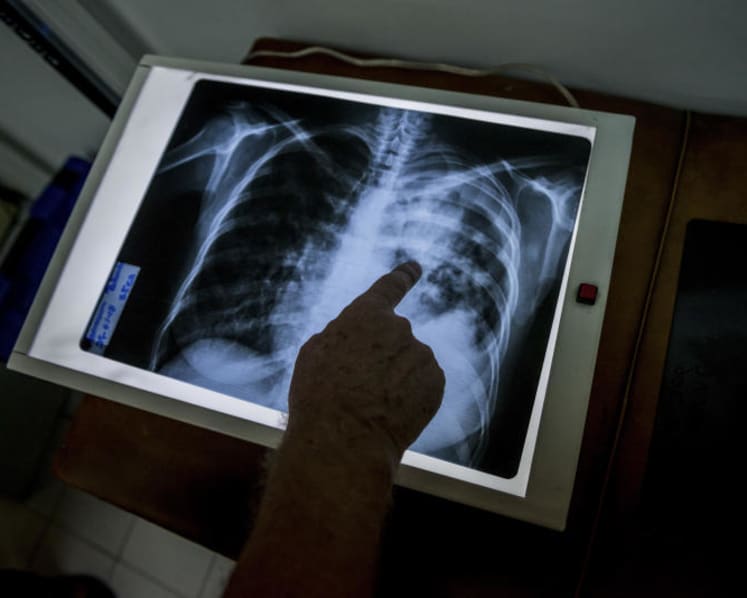 Strategies used in tackling Covid-19 can help to eliminate TB in S’pore