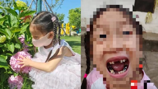5-Yr-Old Girl Loses 4 Teeth After Robot Kicks Her In The Face During Science Museum Visit, May Be Left With Permanent Scar