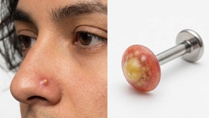 This “Pimple Piercing” Is So Real, You’ll Want To Squeeze It