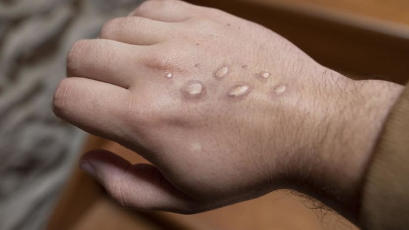 MOH confirms second local case of monkeypox infection in Singapore