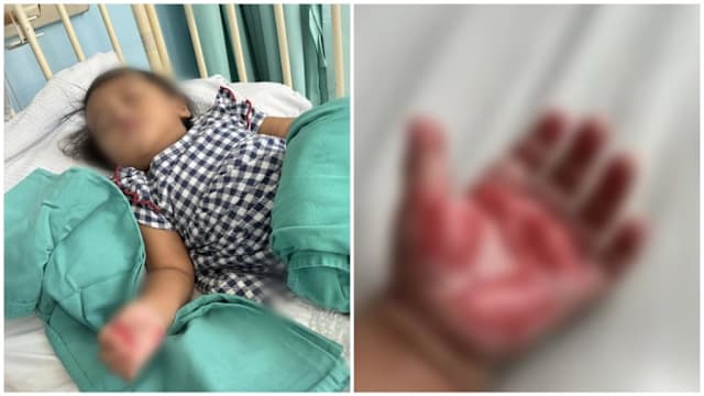 一岁女儿碰不锈钢扶手遭烫伤 母亲贴文提醒家长要小心