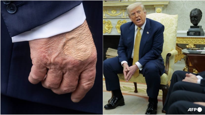 Trump diagnosed with vein issue after leg swelling, hand bruising Trump diagnosed with vein issue after leg swelling, hand bruising