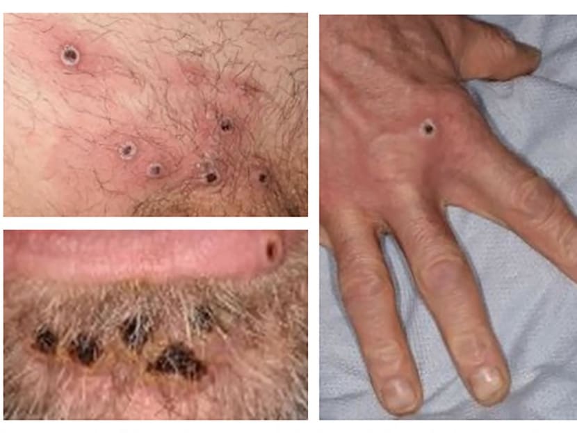 <span style="font-size:16.0pt"><span style="font-family:"Arial",sans-serif">A handout picture made available by the UK Health Security Agency on June 22, 2022 shows images of monkeypox rash lesions on an infected person. </span></span>