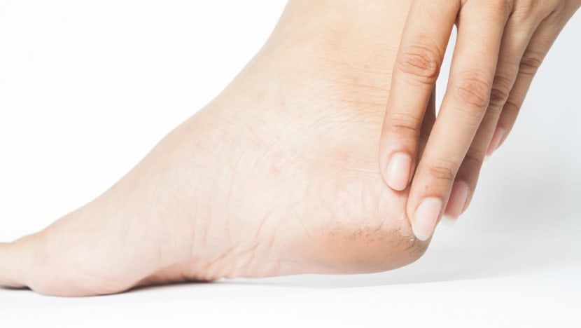  Ini cara elak kulit tumit merekah, jadi kasar