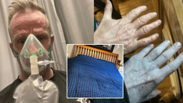 英男醒来全身变蓝如阿凡达  送院才知新床单惹祸