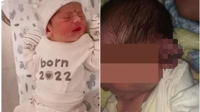 产房停电改用手机照明 大意医生割断初生婴左耳
