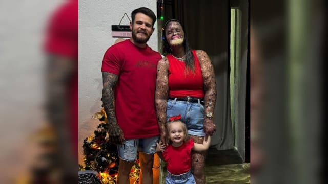 患罕见皮肤病动219次手术 巴西女圆梦诞下健康女儿
